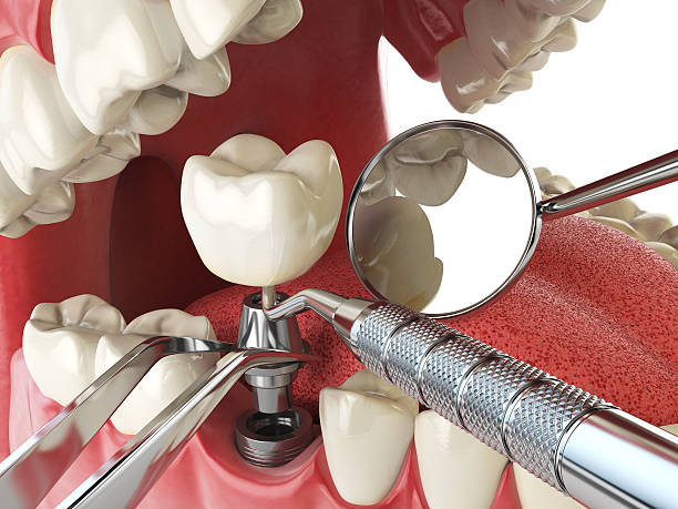 Best Emergency Tooth Extraction in Georgetown, PA